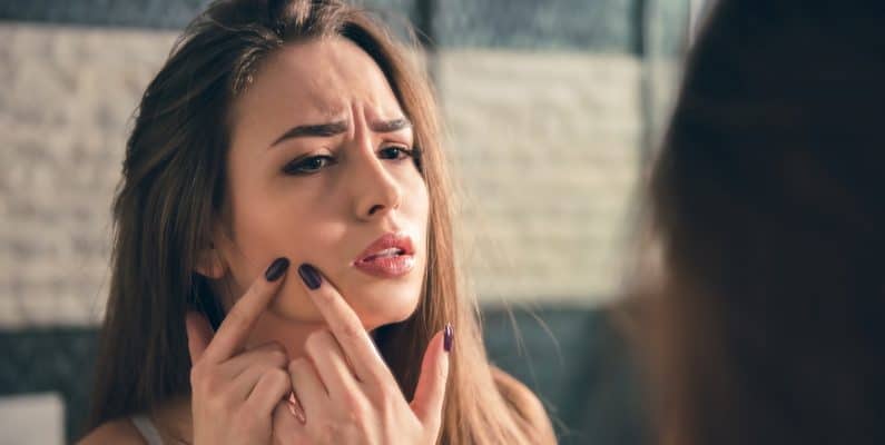 acne around mouth