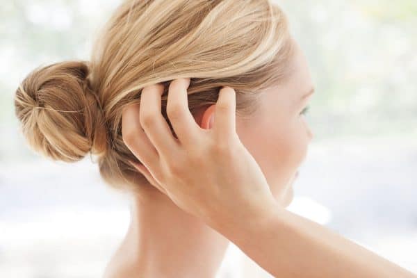 scalp acne